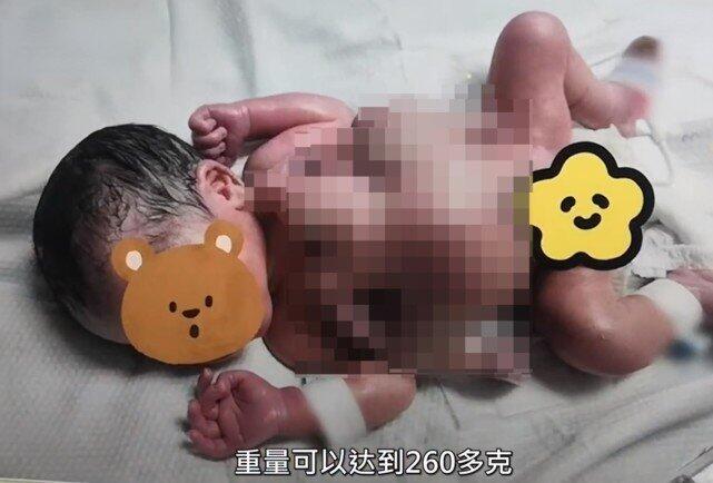 深圳一男婴出生时4手4脚，发生概率50万分之一