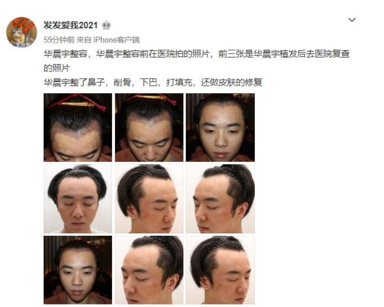 花花整容到什么程度了