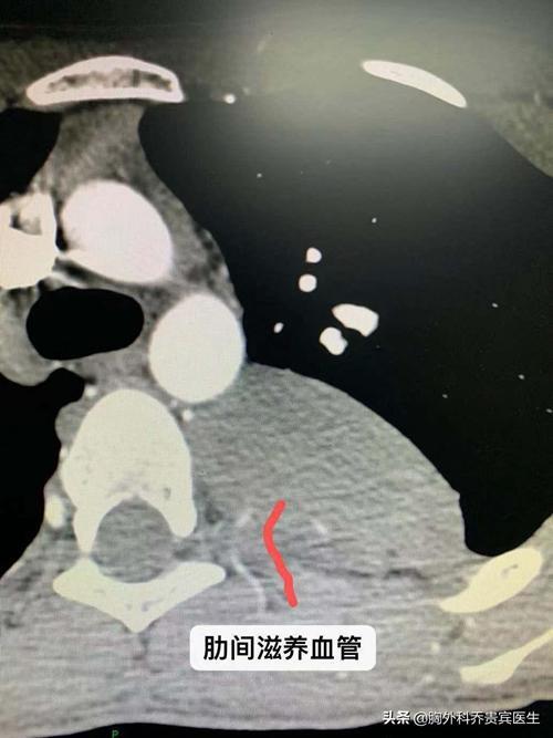 3岁女童胸腔肿瘤如成人拳头大小是怎么回事，关于儿童胸腔肿瘤的新消息。