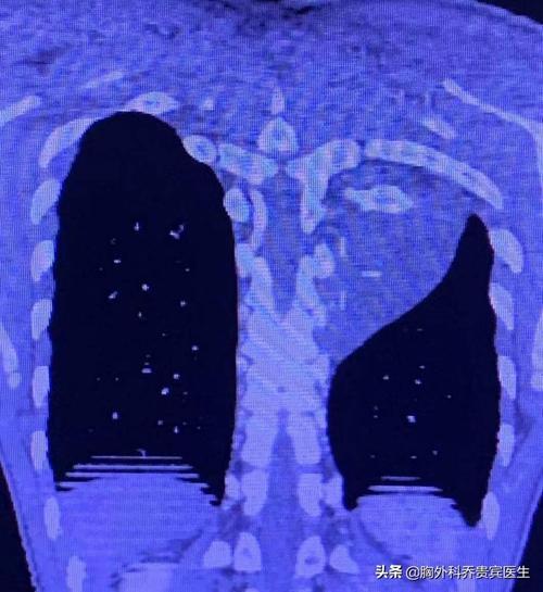 3岁女童胸腔肿瘤如成人拳头大小是怎么回事，关于儿童胸腔肿瘤的新消息。