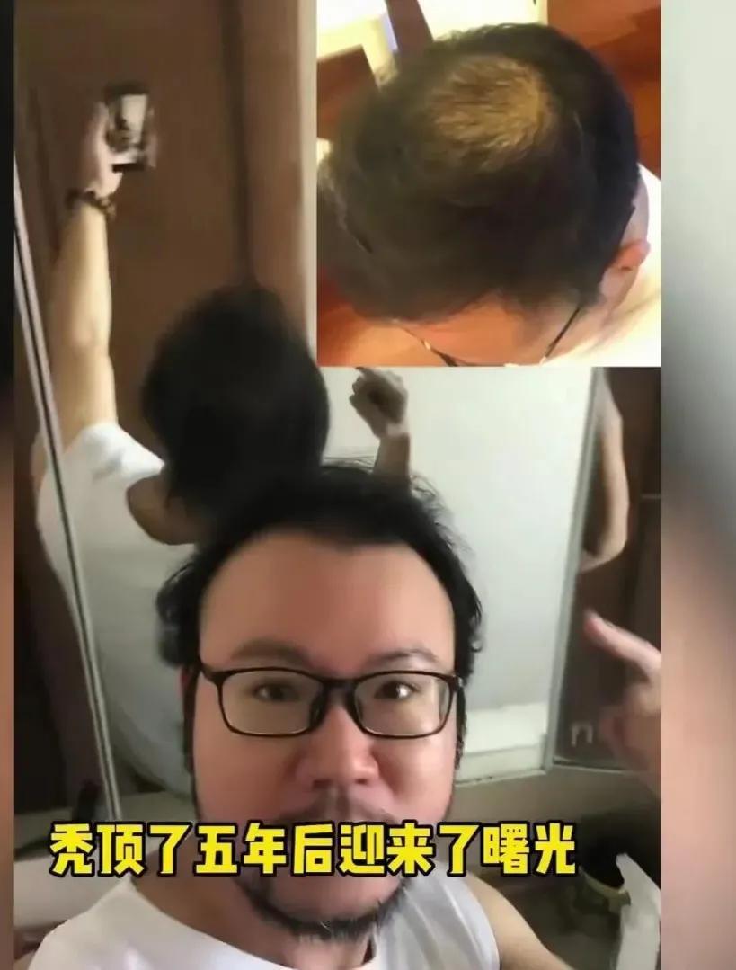 男子半年不用洗发水,男子半年不用洗发水 秃顶变满头黑发