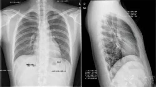 秒懂教学！这下终于会看胸片了 如何看胸片
