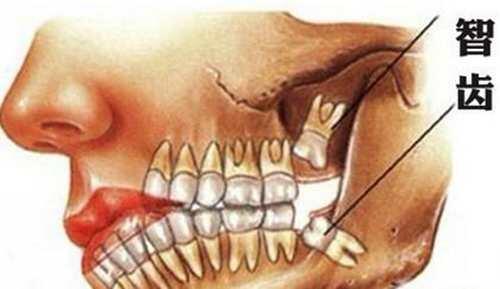 智齿冠周炎有哪些症状