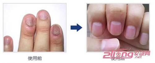 灰指甲的不同症状图片及愈后对比图