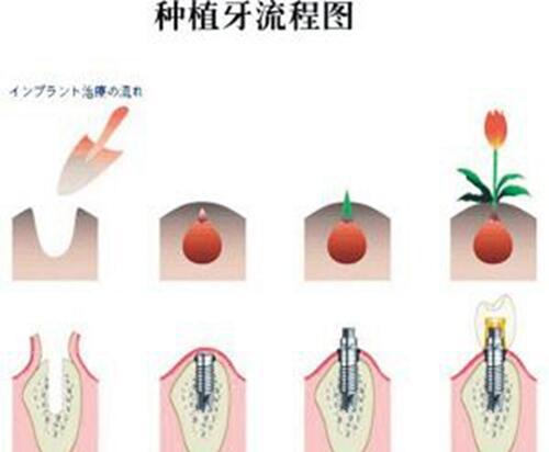 良心医生不建议种植牙